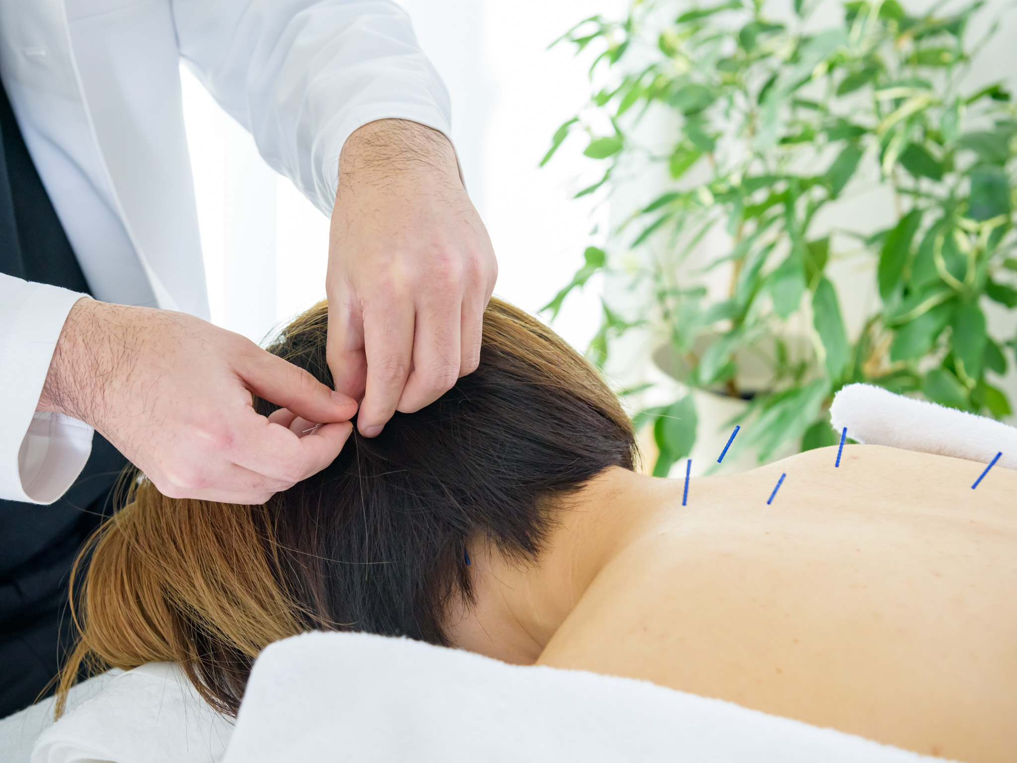 優しい鍼の施術風景