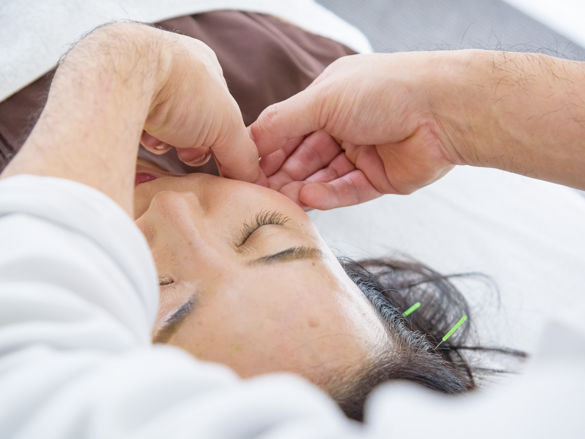 美容鍼＋身体の鍼灸