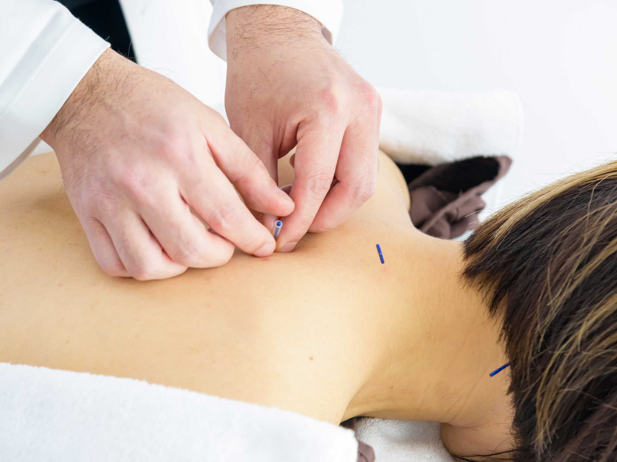 ベーシック 美容鍼＋身体の鍼灸