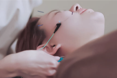 アドバンス 電気を流す美容鍼＋身体の鍼灸