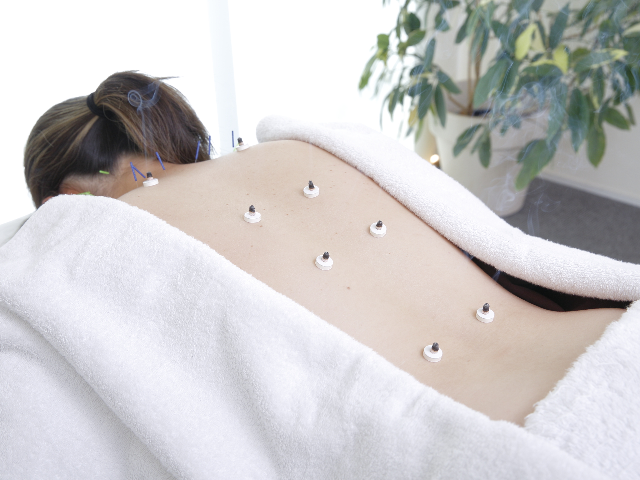 藤沢ですべり症・分離症の鍼灸なら|立つ・反ると痛む腰を体幹から支える