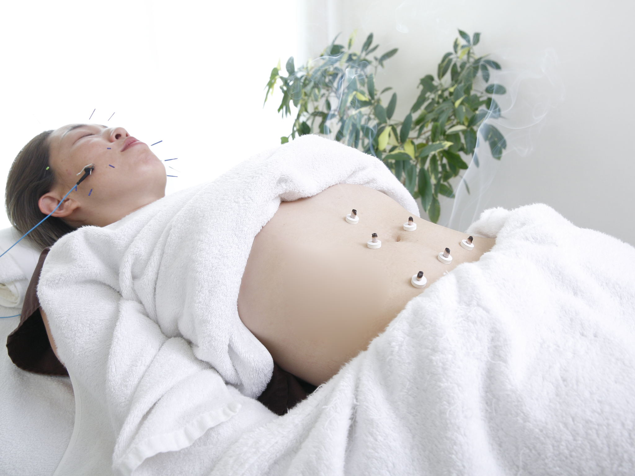 目の下のくま・顔のくすみと美容鍼|血めぐりの視点