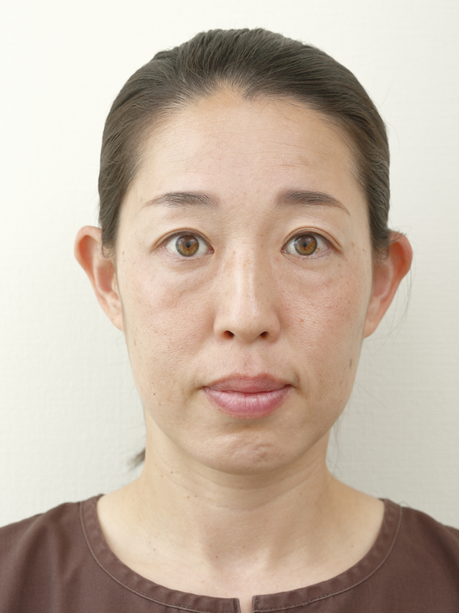 ストレスと円形脱毛症|東洋医学の「血熱生風」から考える