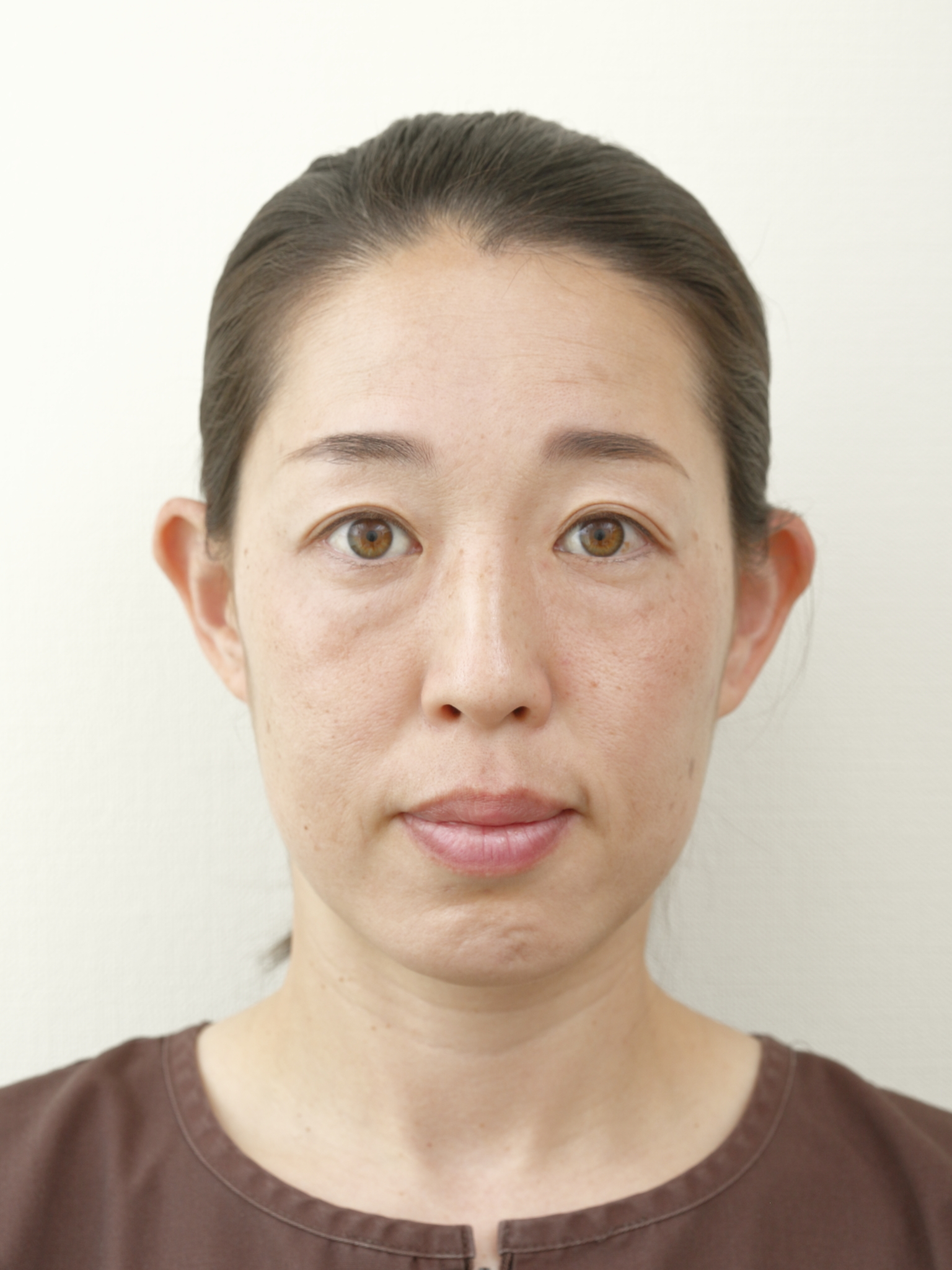 東洋医学でみる頭痛の4タイプ|あなたの「証」と鍼灸
