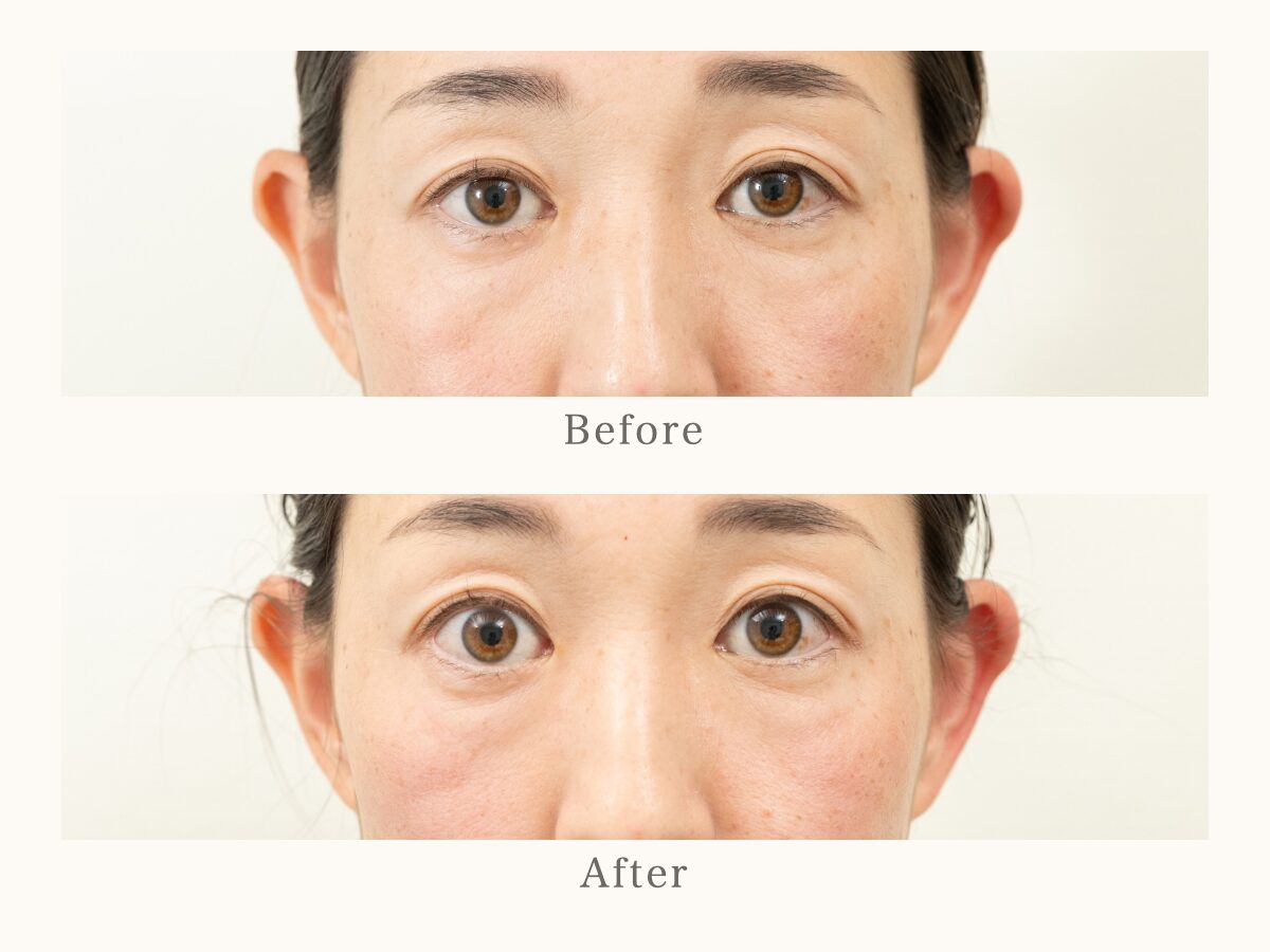 目元の美容鍼 Before After