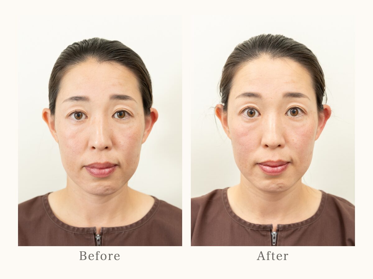 お顔全体の美容鍼 Before After