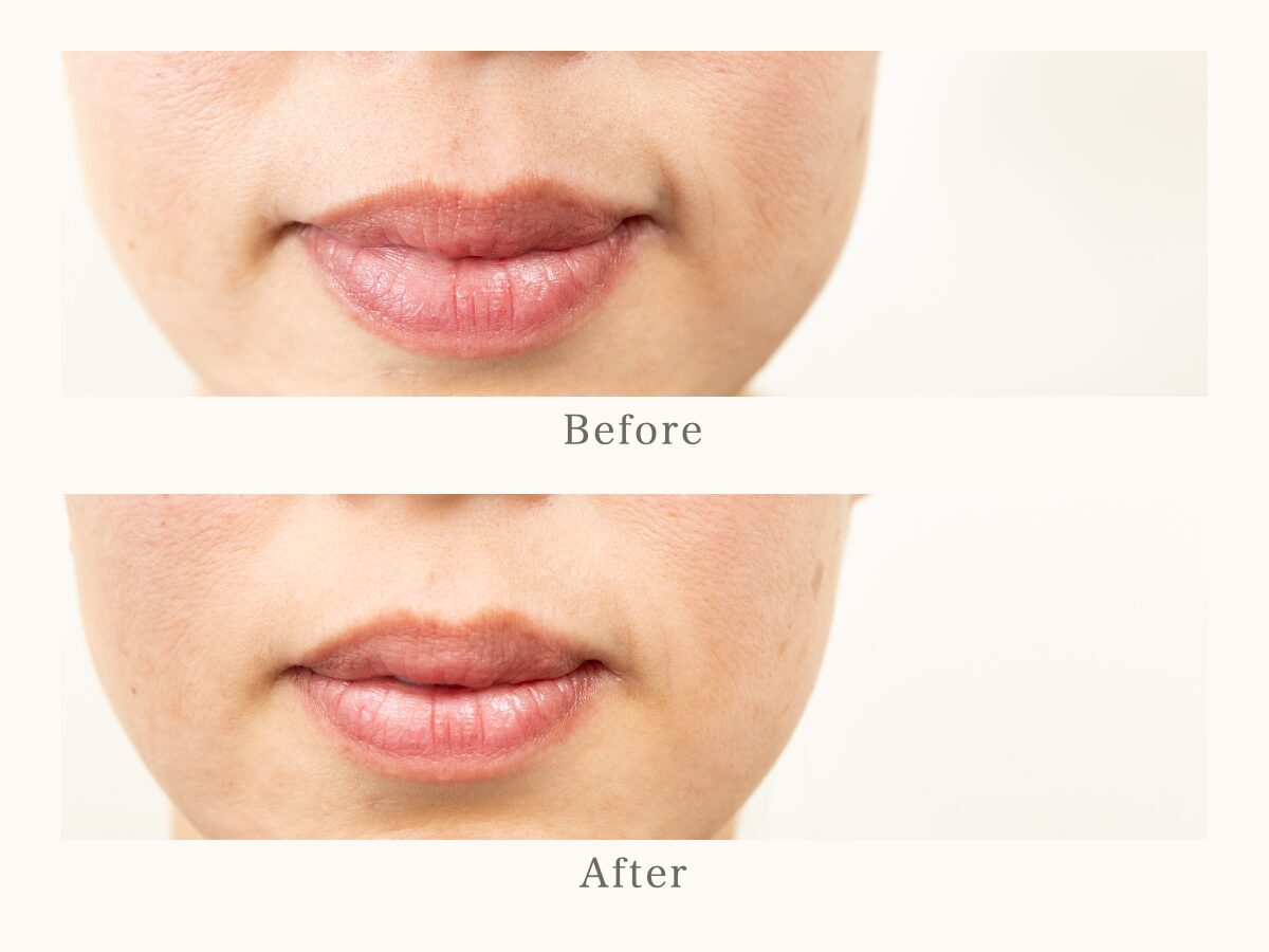 フェイスライン・口元の美容鍼 Before After
