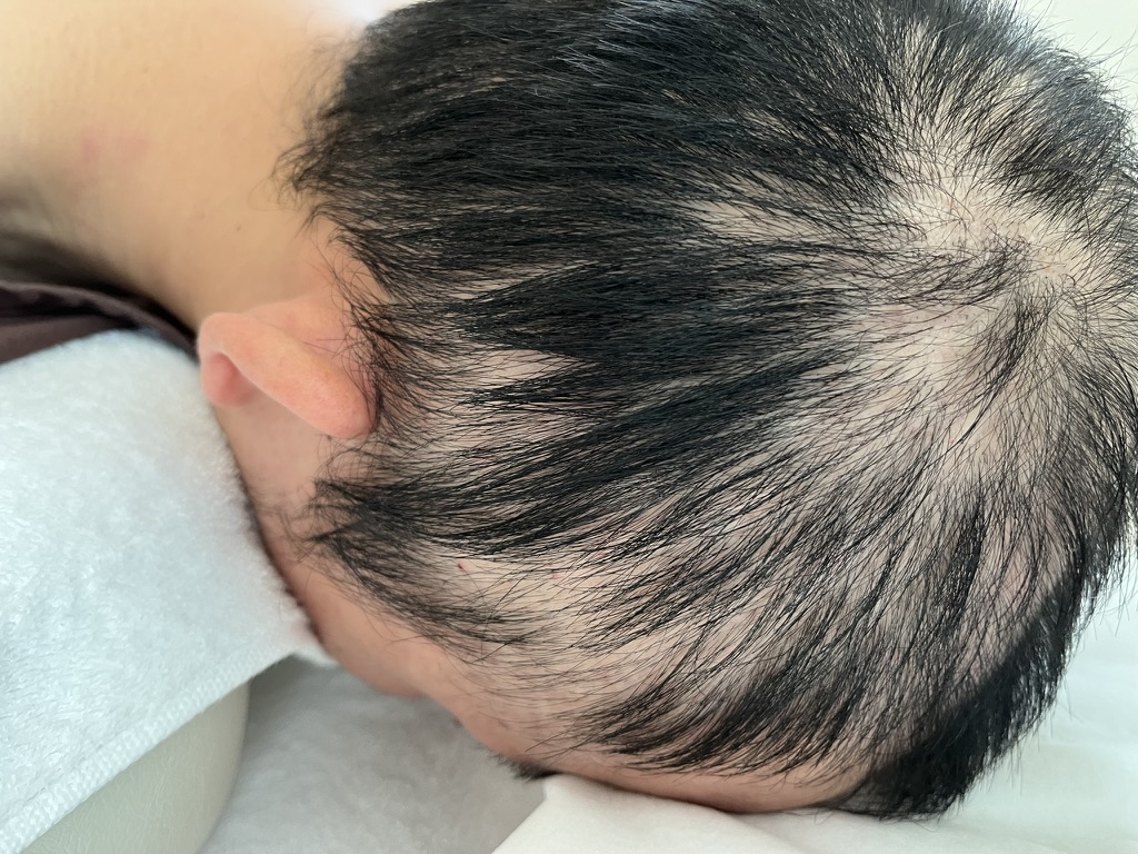 円形脱毛症・乾癬を伴う脱毛症 初診時の状態（症例）